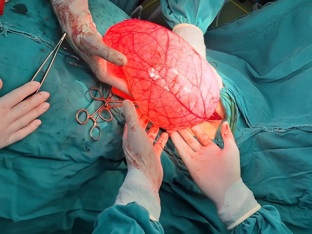 tumor težak 4 kg, dečija hirurgija ZC Valjevo